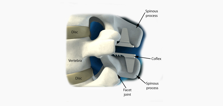 Decompression With coflex Extends Durability, Sustainability
