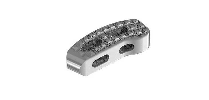 Stryker 3D-Printed Lumbar Cage Cleared