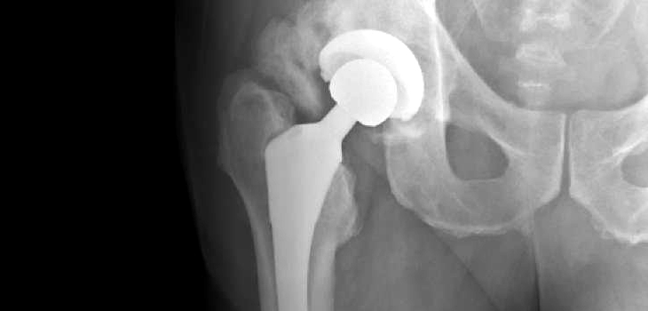 Supine Anterior THA Trumps Posterior and Fluoroscopy Helps!