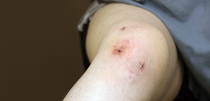 Improving Allograft Availability Focus of ESSKA Initiative