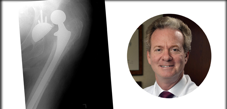 THR Dual Mobility Implant: ZERO Dislocations
