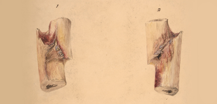4 Factors Associated With Fracture Nonunion
