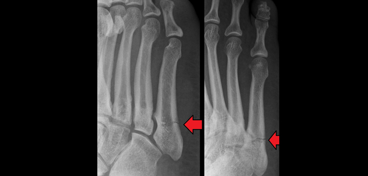 Plates Versus Screws Touted to Repair Jones Fractures