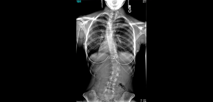 Adult Spinal Deformity Guidelines; Study: Knee Stability Tied to Medial Line; Deformity Surgery Costs Much Higher in U.S.