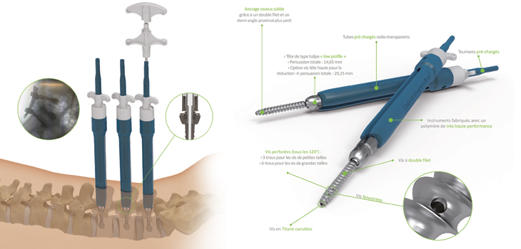 Safe Orthopaedics Hits 10,000 Surgical Kit Mark