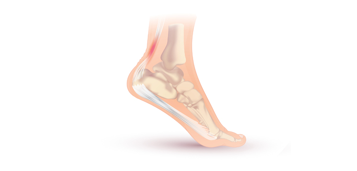 New Agreement Makes TenJet System Available to U.S. Patients
