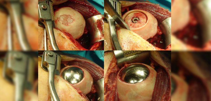 Arthrosurface Stemless Shoulder Cleared by FDA