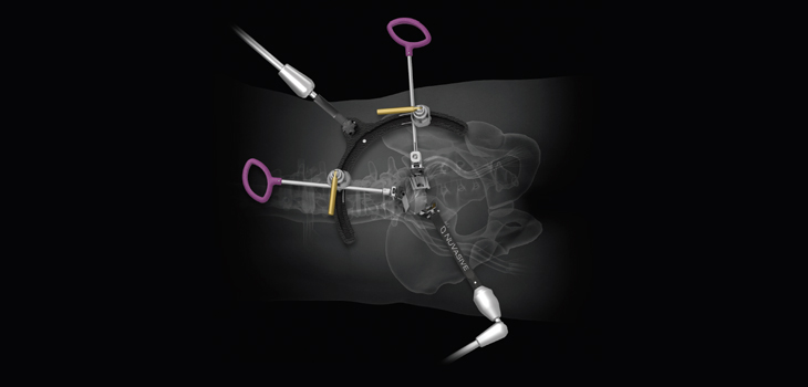 NuVasive Launches Retractor for Lateral, Supine Approaches