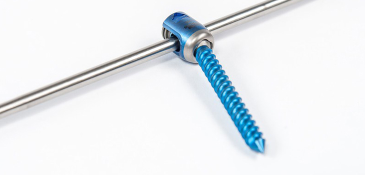 Spinal Resources: First Implantation With Swedge System