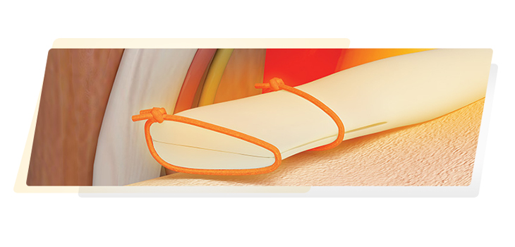 Quick FDA Clearance for Meniscus Repair Instrument