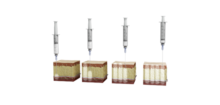 FDA Approves Shoulder Indication for Exparel