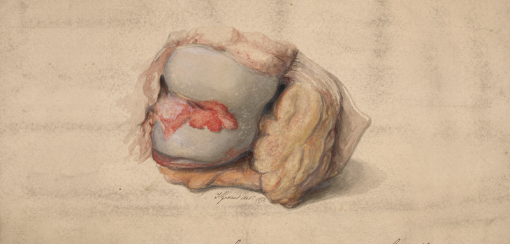 Comparing Bipolar Knee Chondral Defect Treatments
