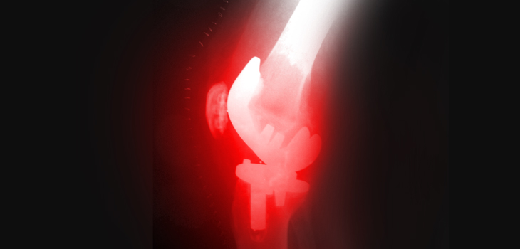 2-Stage vs Irrigation for Infections in Unresectable Joints