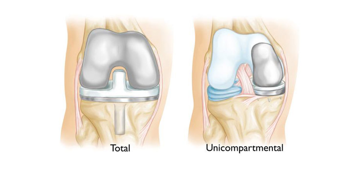 10-Year Uni Arthroplasty for Osteonecrosis Data