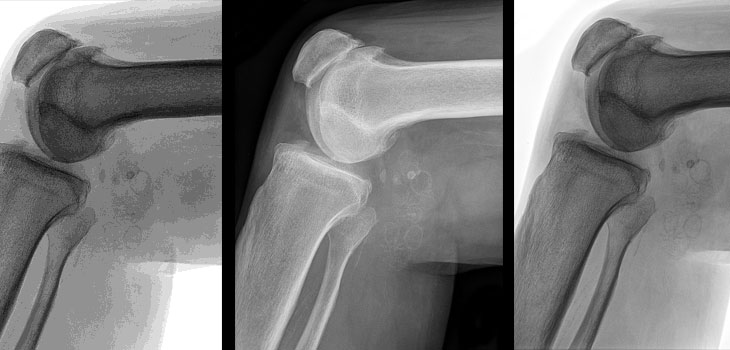 New Knee Drug, TPX-100, Shows Signs of Cartilage Regeneration