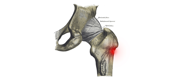New Hope for Patients With Peritrochanteric Pain