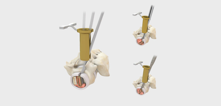 SpineCraft Launches PANORAMA Retractor