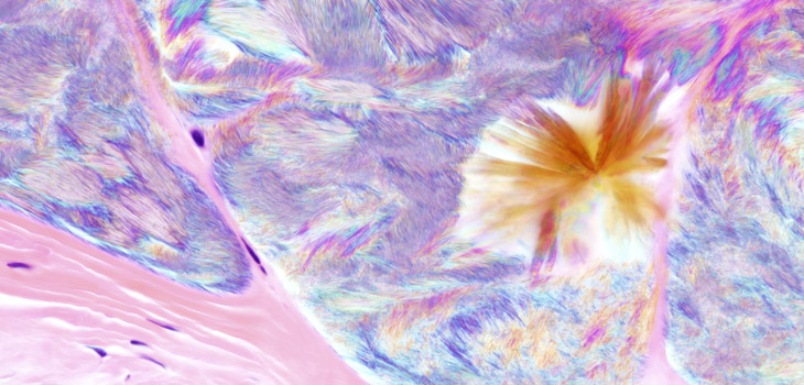 New Study: Gout May Not Increase Fracture Risk