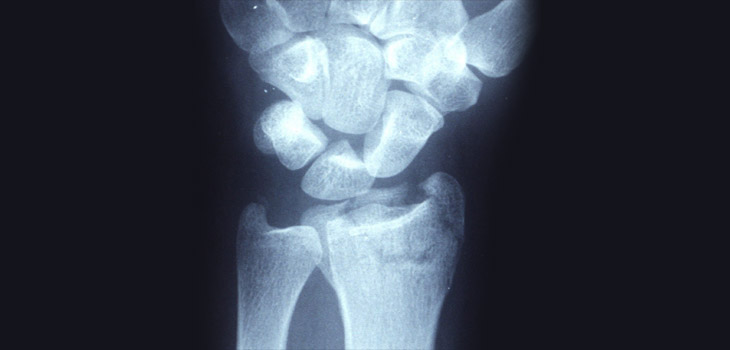 12-14 Year Follow-Up Data for Distal Radial Malunions