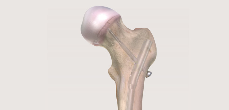 OrthoPediatrics’ Femoral Nail for Kids Cleared by FDA