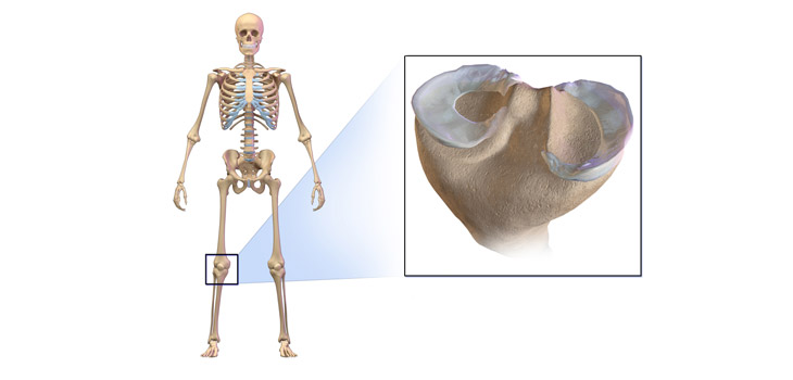 Efficacy of Meniscus Knee Surgery Questioned
