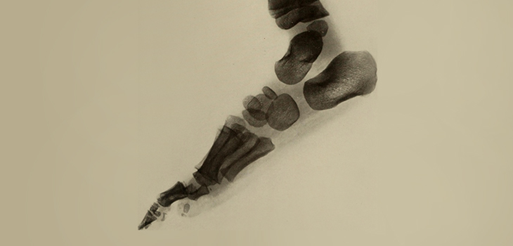 Talar Lesions…Allograft No Better Than Microfracture?