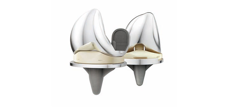 Updated Clinical Data for DePuy’s ATTUNE Knee