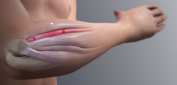 Muscle Allograft Speeds Muscle Recovery, Regeneration?