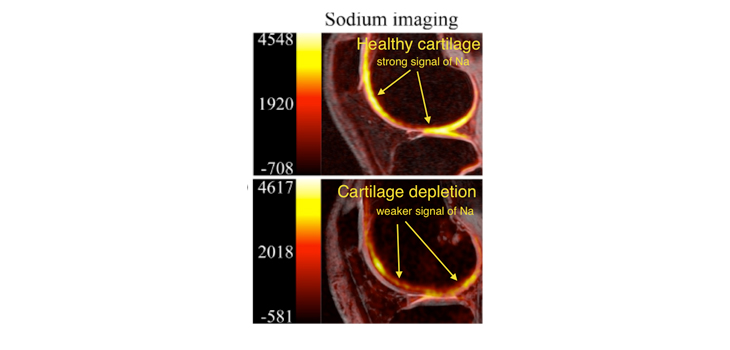Earlier OA Detection With PET-MRI