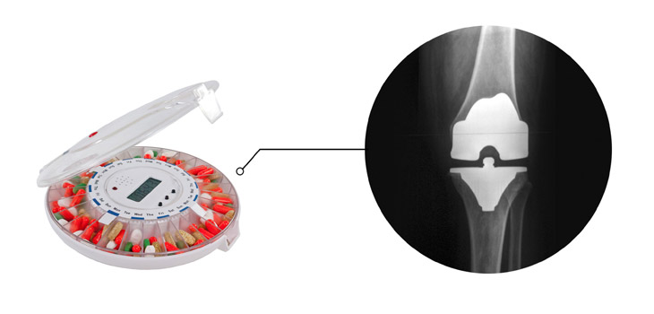 Teasing Out Self-Medicating Patterns Before TKR