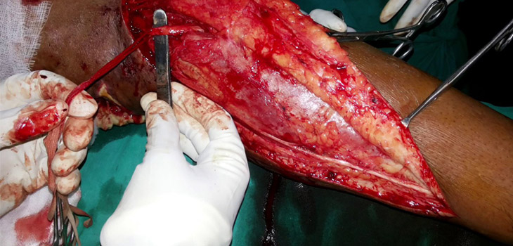 10-Year Data for Using Gastrocnemius Flap in TKA