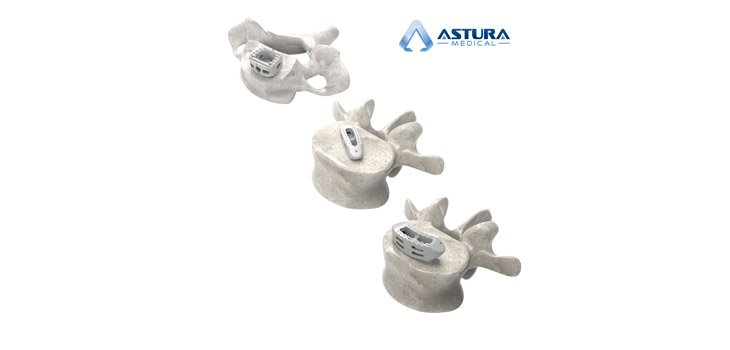 Astura Medical’s Cervical and Lumbar Spacers Cleared
