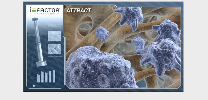 Novel Peptide vs. Allograft in New Fusion Study
