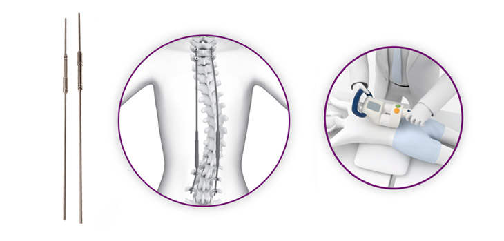Upgraded MAGEC X for Early Onset Scoliosis