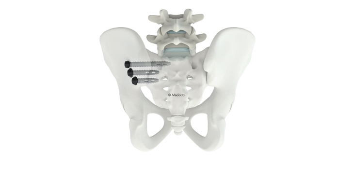 Medacta: First-in-Man With New SI Joint Screw