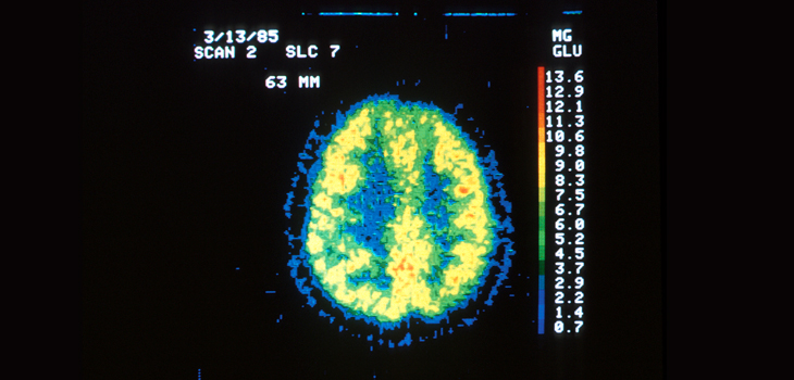 Joint Inflammation Linked to Cognitive Decline?