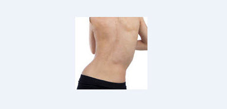 New Data on Scoliosis and Quality of Life