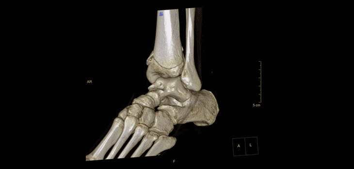 Ankle Salvage Possible After Distal Tibial Nonunion