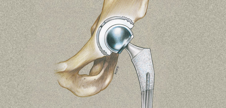 Stryker Safety Notification for Certain Femoral Heads