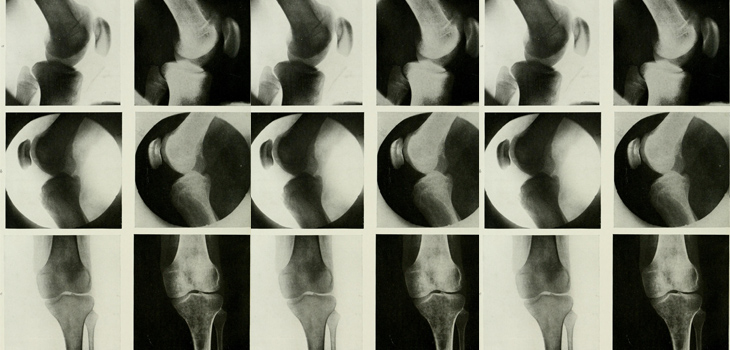 Are Knee OA Stats Reliable? Maybe Not