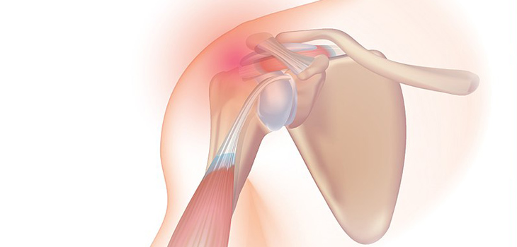 New Study Quantifies Long-Term Acromioplasty Outcomes