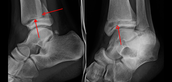 Fracture Patterns in Triplane Fractures