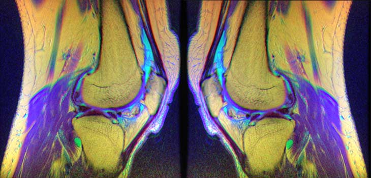 New Study: Not all Knee Aging is Pathological