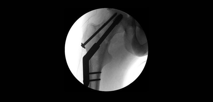 Global Call to Action on Fragility Fractures