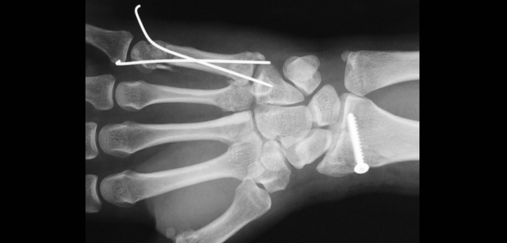Fixing Fractures on a Global Scale