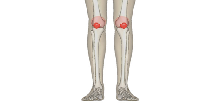 Physical and Mental Health Lower With Knee Pain