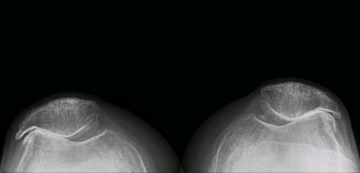 New Algorithm for Modeling Osteoarthritis Progression