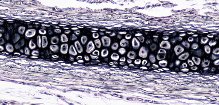 Sprifermin Grows Cartilage in OA Patients?