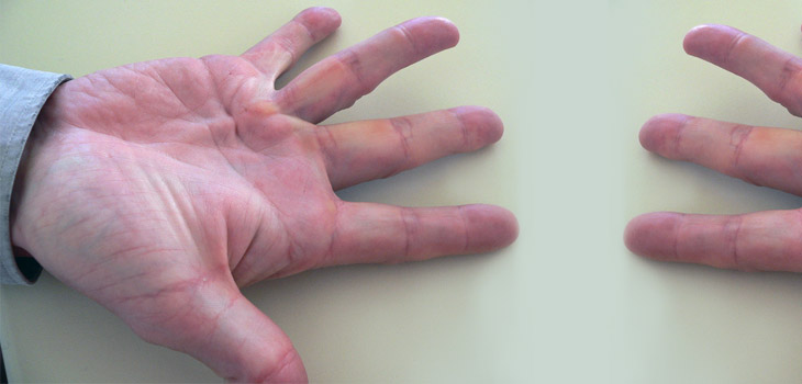 Drug Proves Successful in Treating Dupuytren’s Disease