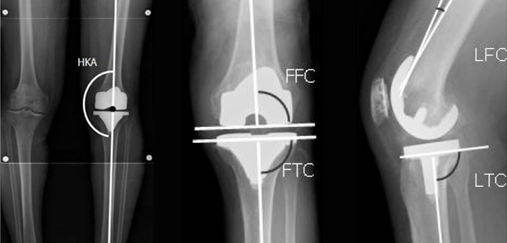 Knees: Off-the-Shelf vs. Customized Implants
